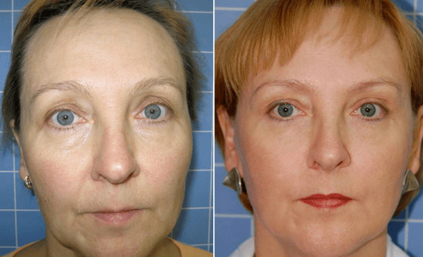 Virun an no der Rejuvenation Prozedur