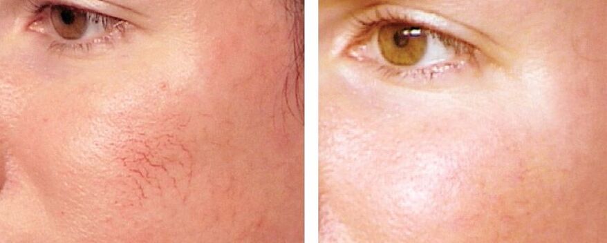 Ewechhuele vu Rosacea