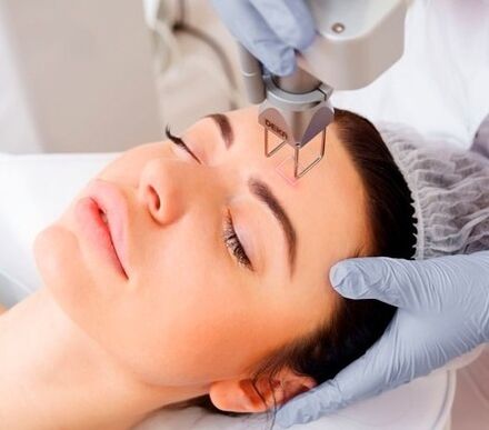 d'Essenz vun der fractional Laser Gesiicht Haut Verjüngung Prozedur