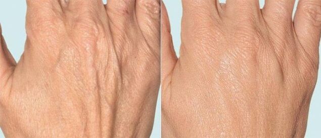 Hand Haut virun an no fractional Therapie