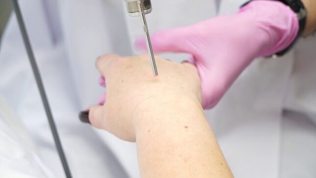 Laser Hand Haut Verjüngung